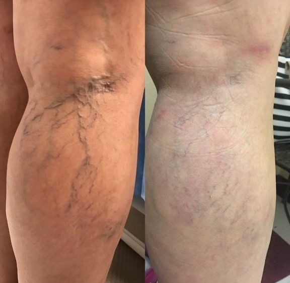 Antes e depois Maria S., 54 anos