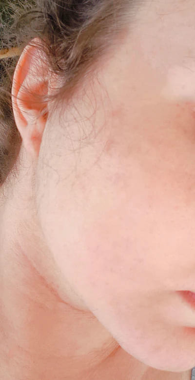 Après traitement anti-acné