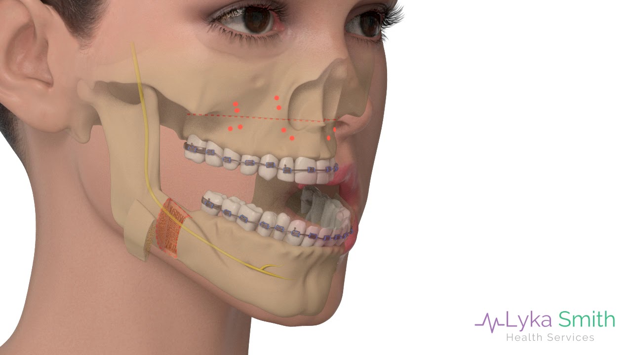Jaw Surgery