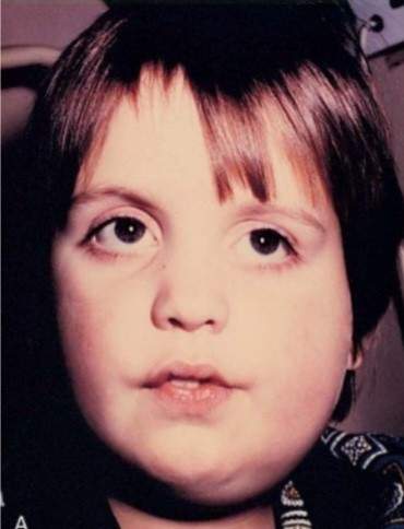 Clinical photograph showing a child with unilateral parotid swelling obscuring the angle of the jaw, characteristic of mumps