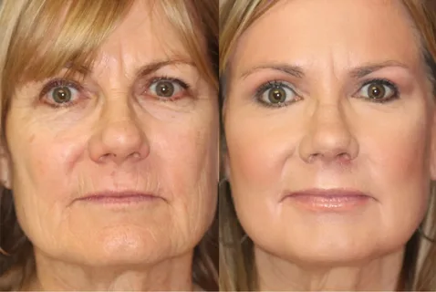 Before skin