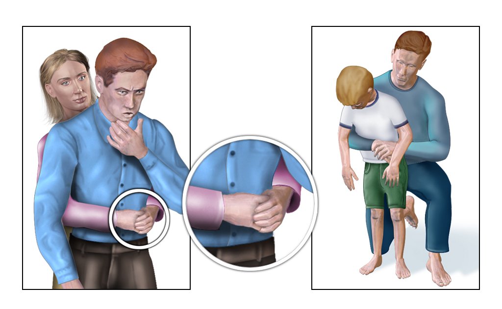 Manovra di Heimlich, come si esegue la tecnica che ha salvato la vita alla Marcuzzi Manovra di Heimlich, come si esegue la tecnica che ha salvato la vita alla Marcuzzi