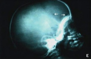 Skull X-ray showing lytic lesions in Langerhans cell histiocytosis
