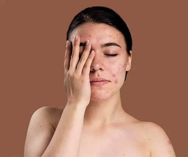 It is one of the most common skin issues in teenagers as well as in adults.Acne generally appears wh