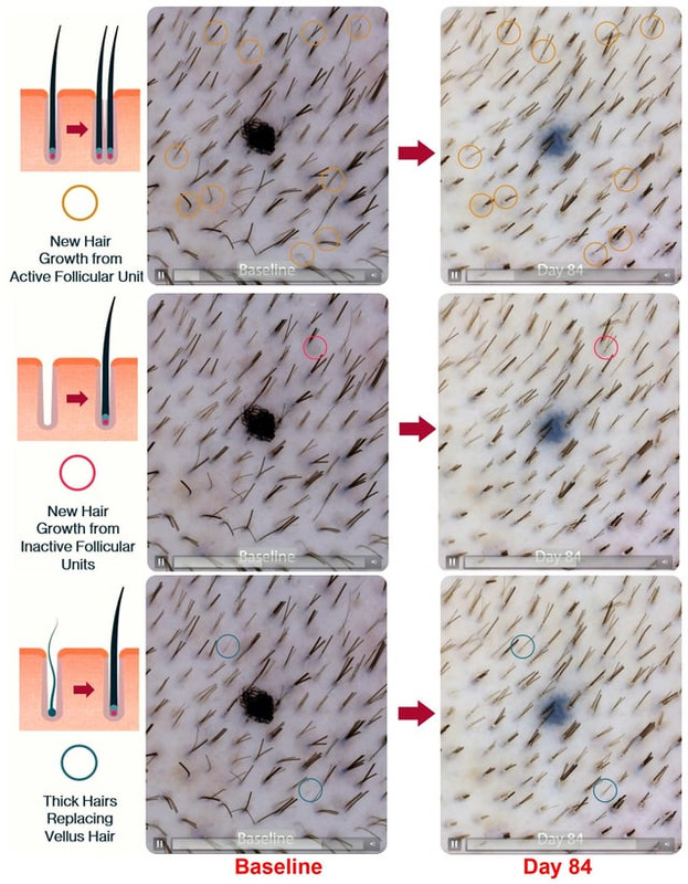 pelage pp405 new hair growth from inactive follicular units v0 upc0m0h7nvrg1