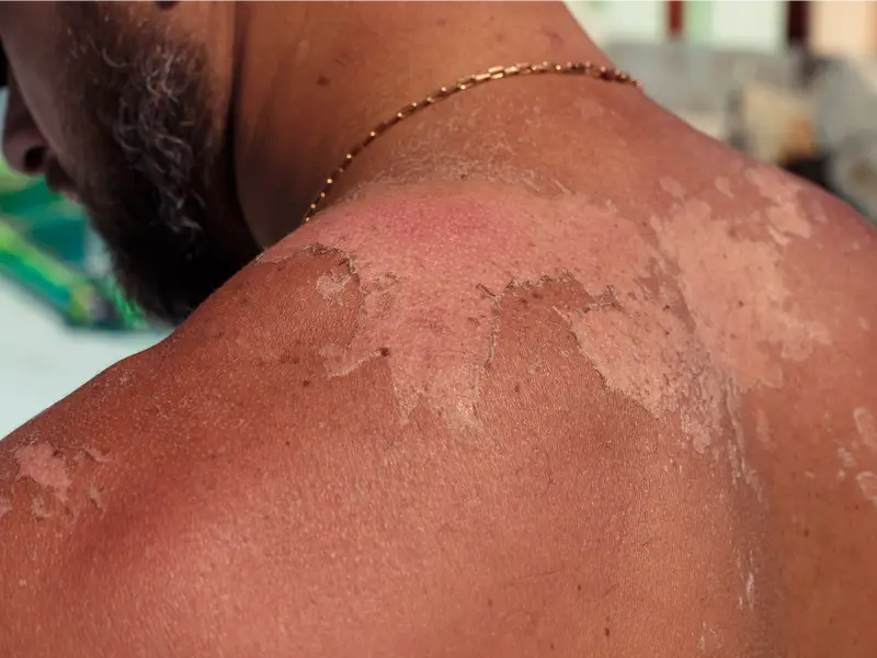 Sunburn Treatment
