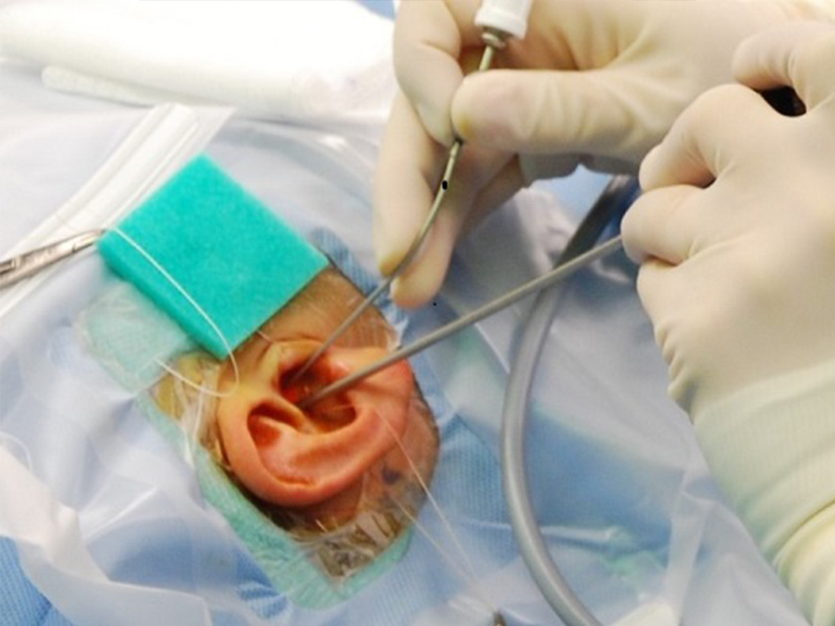 Ear surgery