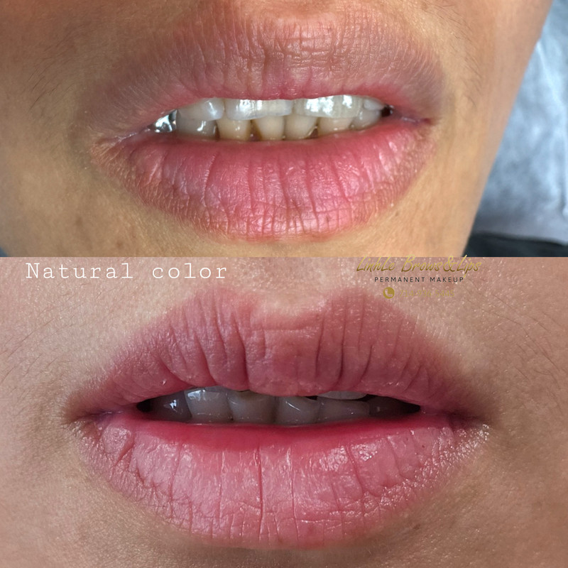 Lip Enhancement Example 6