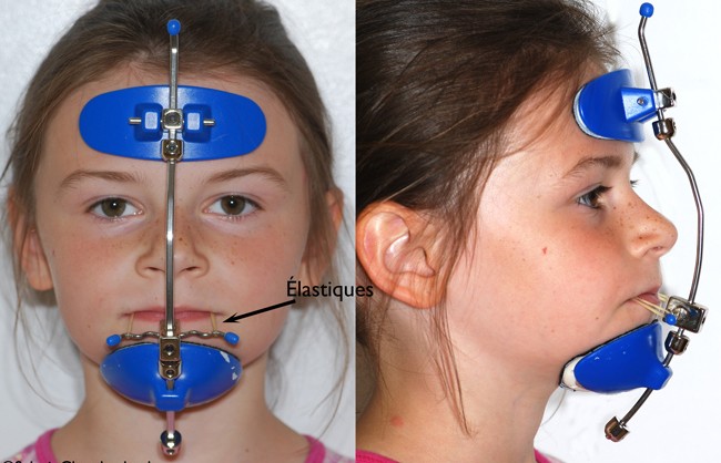 Myofunctional Appliances (for kids)