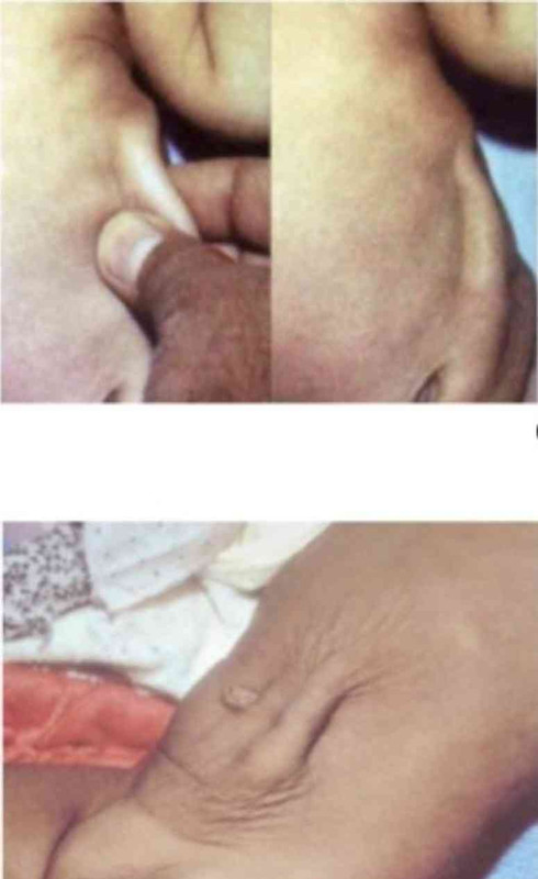Clinical photograph showing signs of dehydration in a child: sunken eyes, dry mucous membranes, poor skin turgor