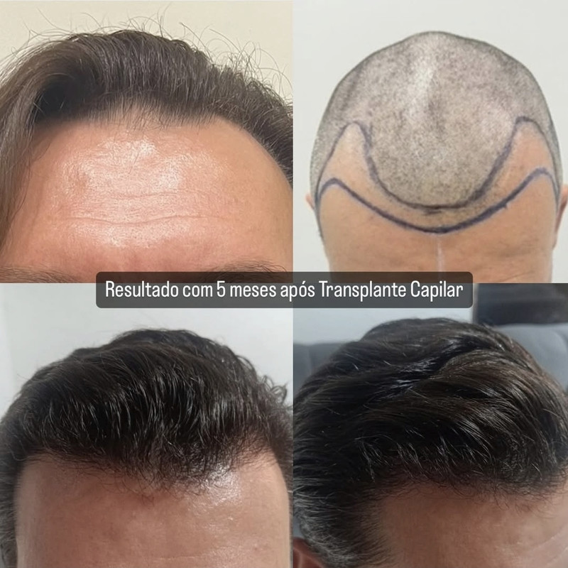 Resultado de tratamento capilar
