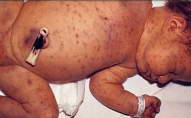 Clinical photograph showing a newborn with purpuric rash (blueberry muffin) and hepatosplenomegaly, characteristic of congenital rubella syndrome