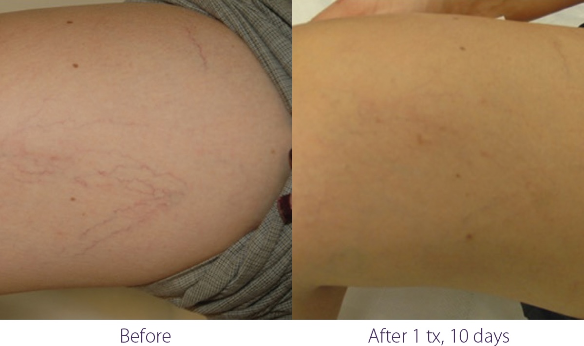 Before and after IPL treatment for visible veins at Let's Face It Med Spa in Denver.