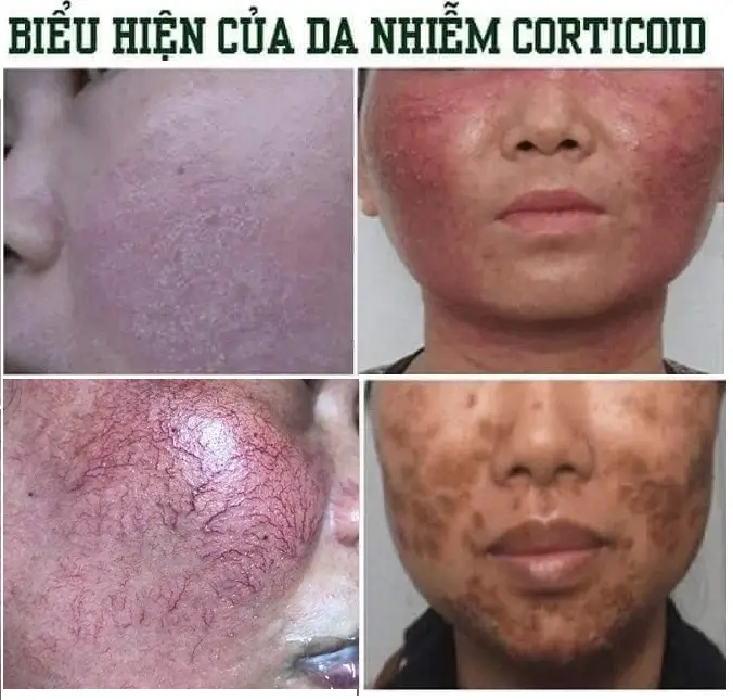 Da bị nhiễm độc Corticoid nặng