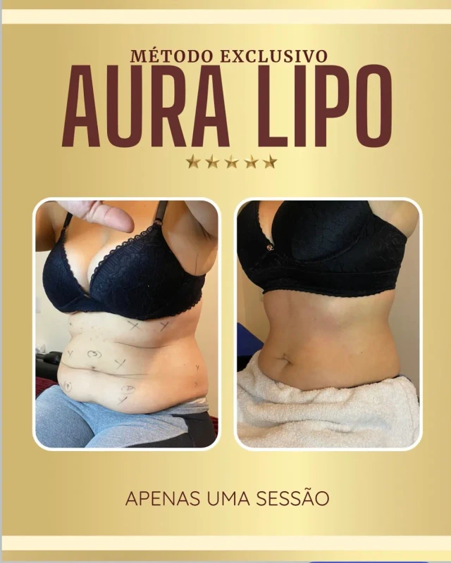 Resultados Aura Lipo - antes e depois