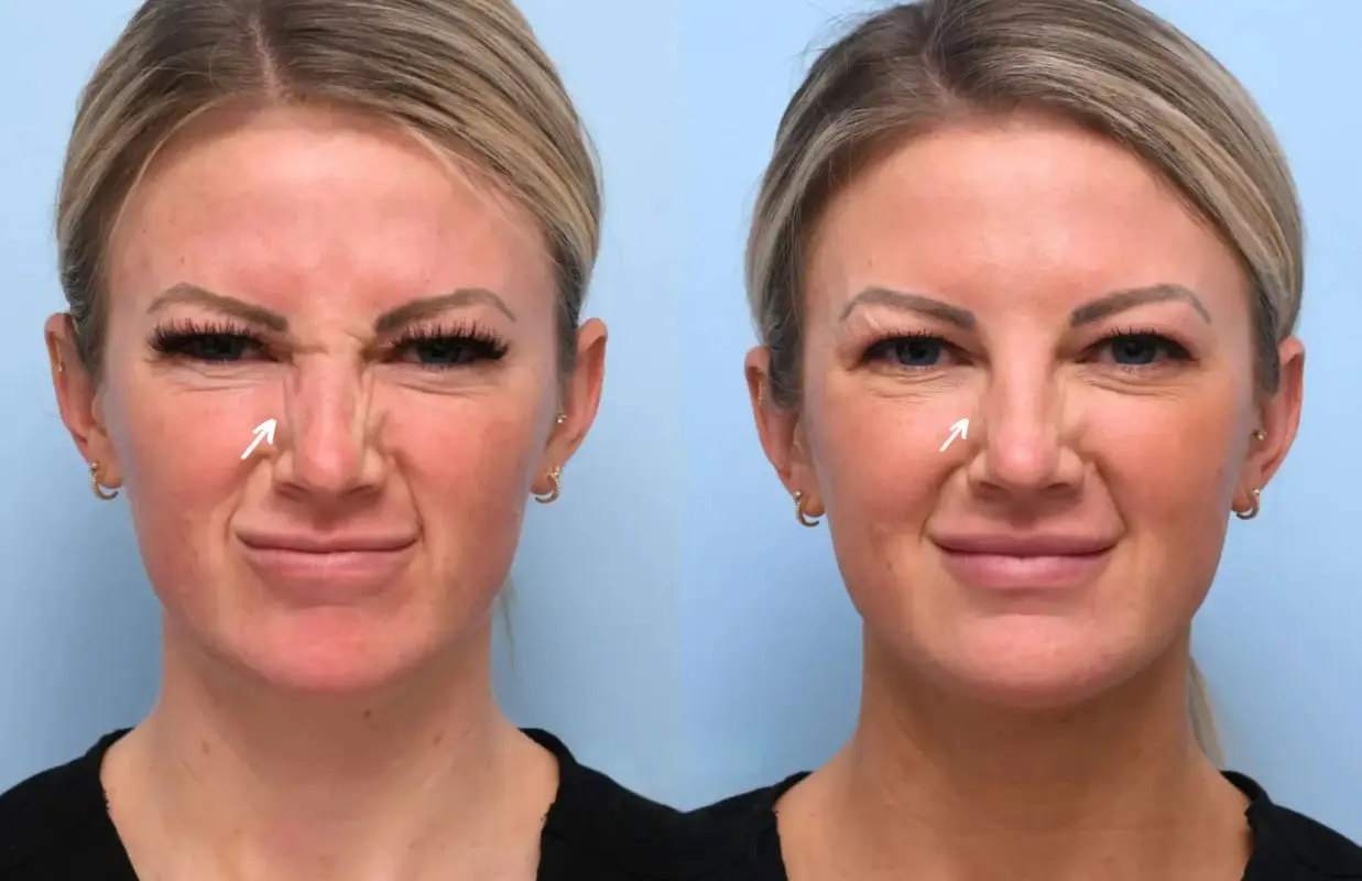Botox in dubai