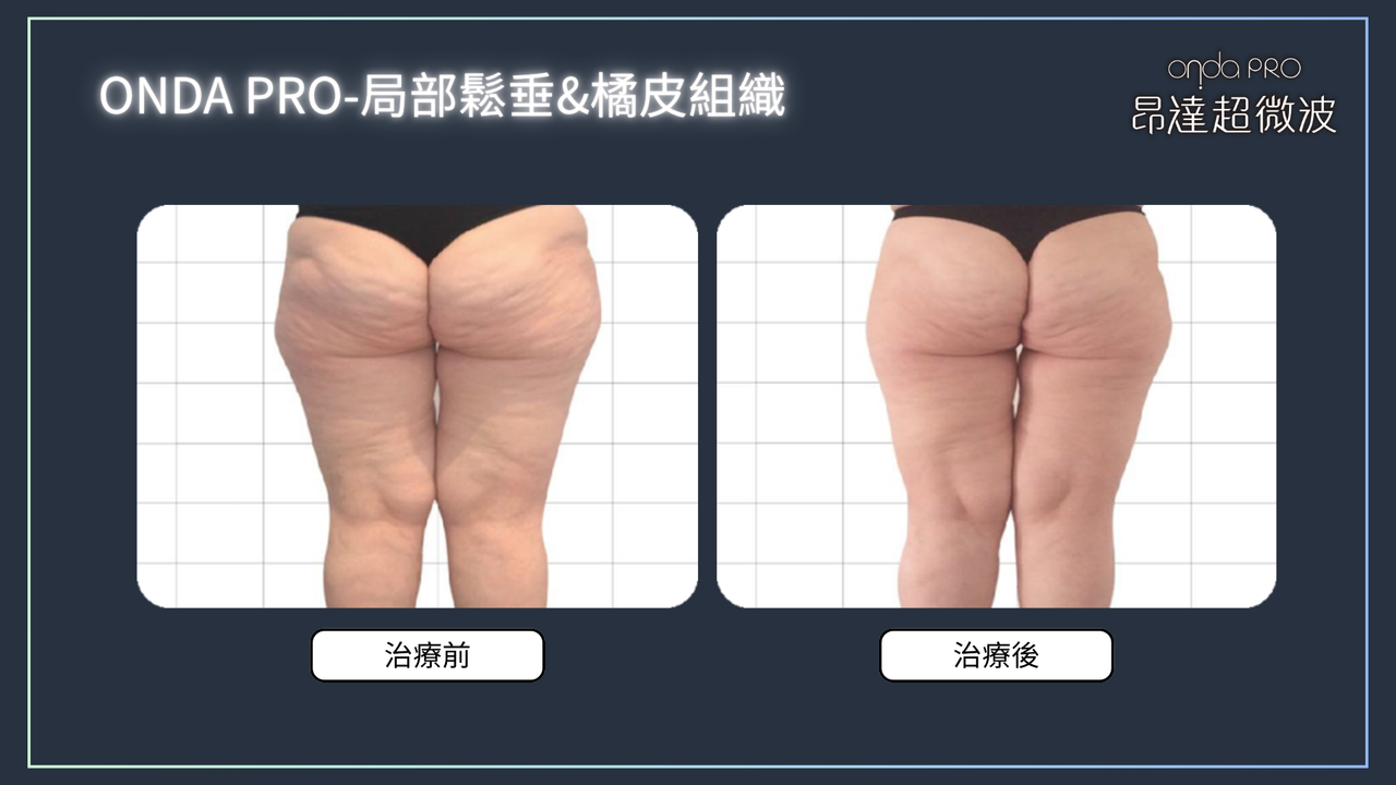 昂達超微波案例：橘皮改善