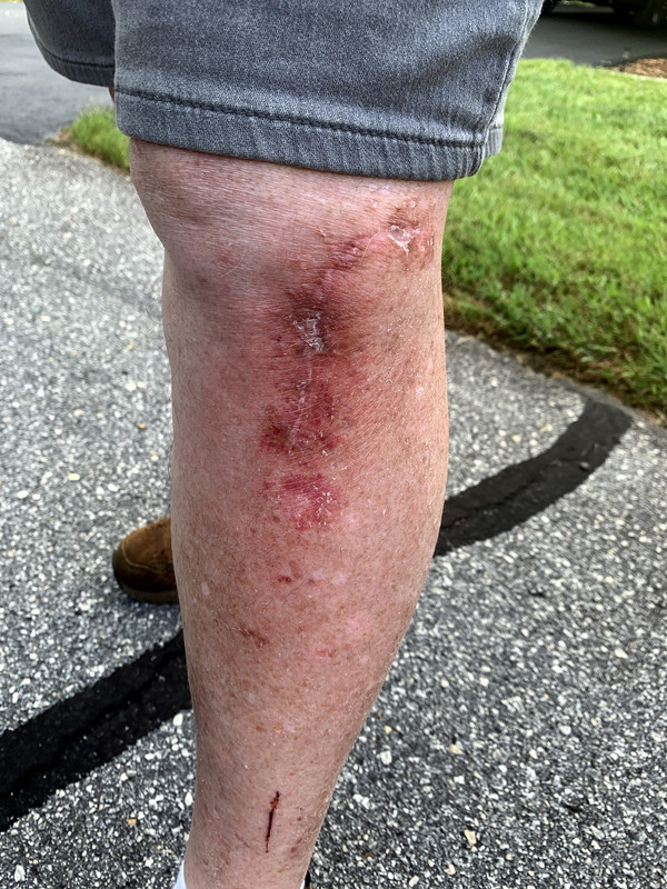 [Image: leg-infection.jpg]