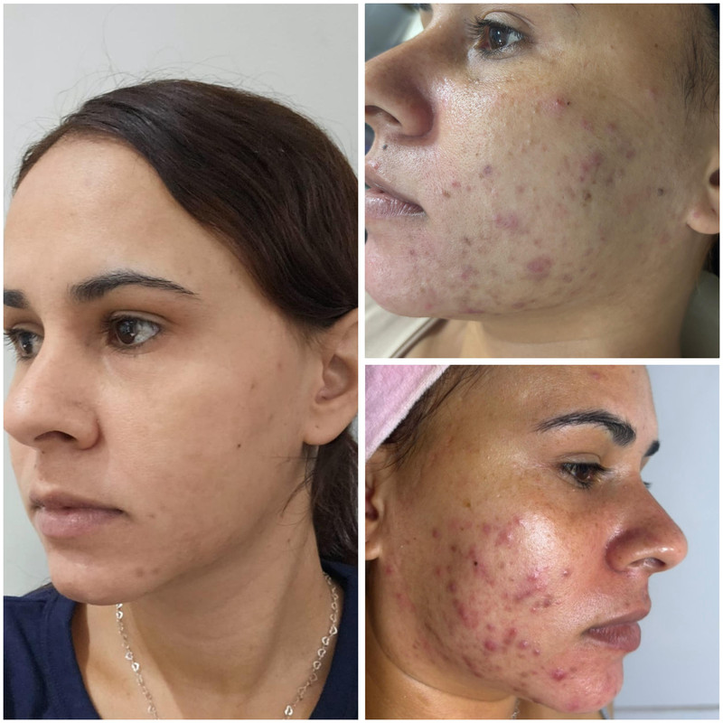 DERMASYNC® Tratamento Antiacne