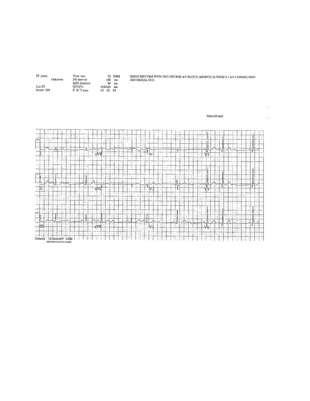 Susan EKG Mobitz II_1