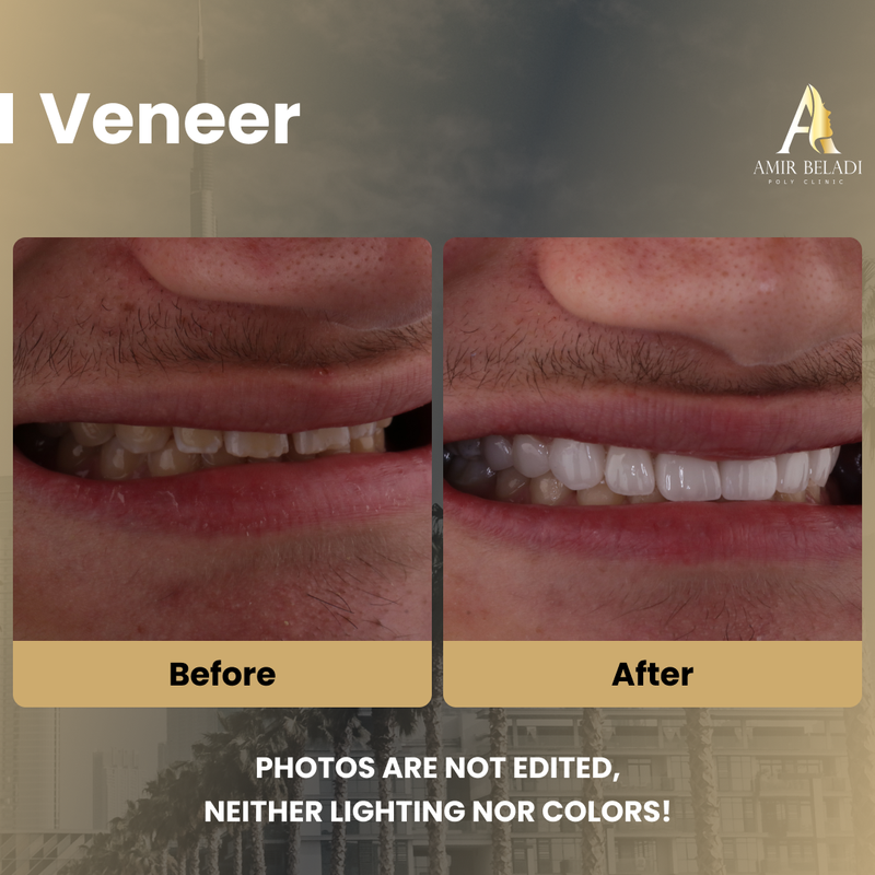 Before/After Smile 3