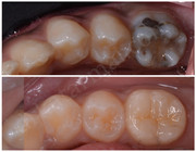 Caries Treatment