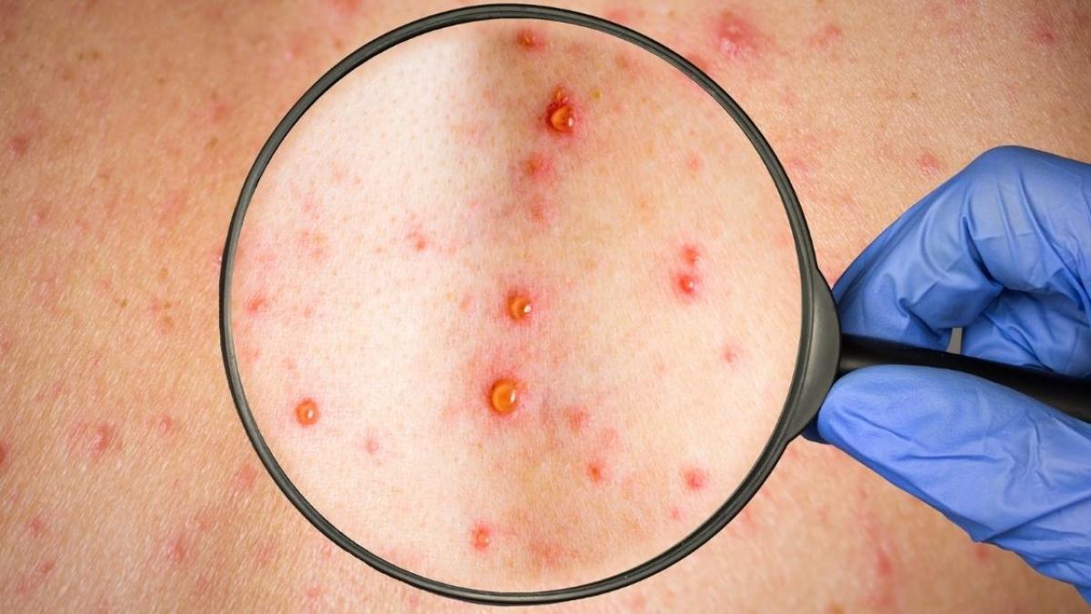 Habrá más casos de viruela del mono, advierte OMS