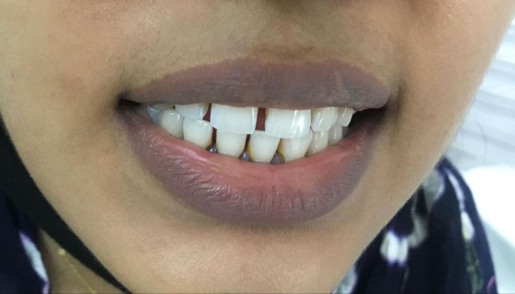 White smile after