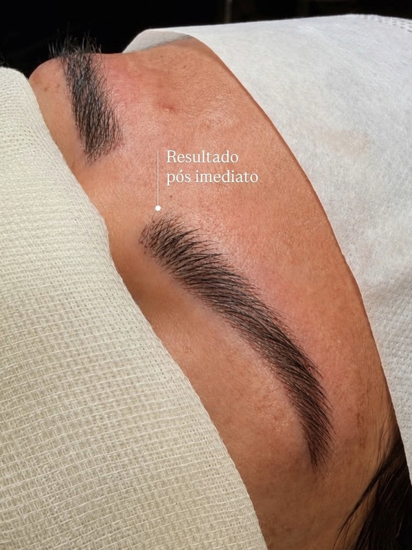 Resultado de transplante de sobrancelhas 3