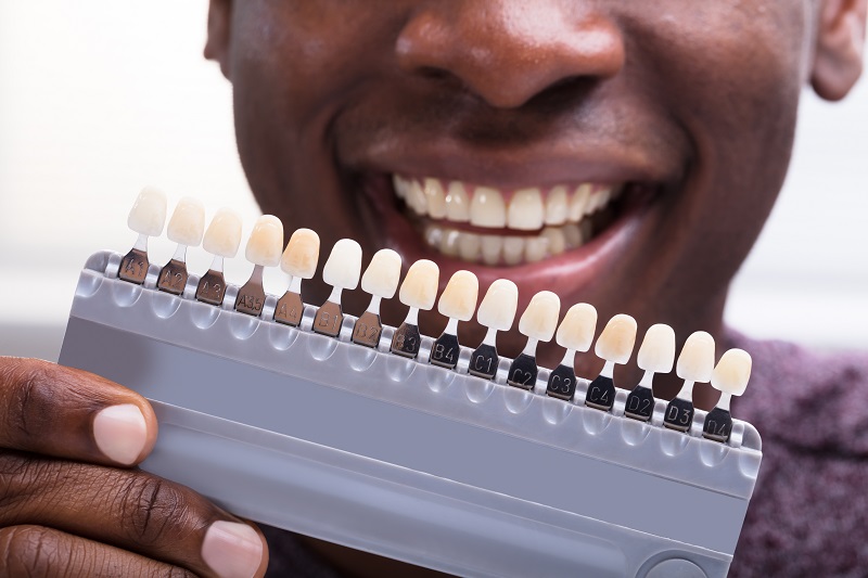 zirconia laminate crowns