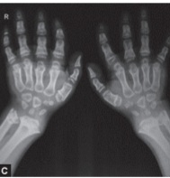 Hand X-ray showing proximally pointed and tapering (bullet-like) metacarpals in MPS