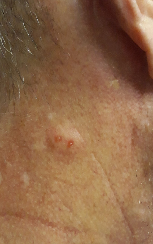 spider-bite-neck-2.jpg