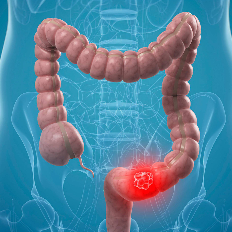 Colon Health