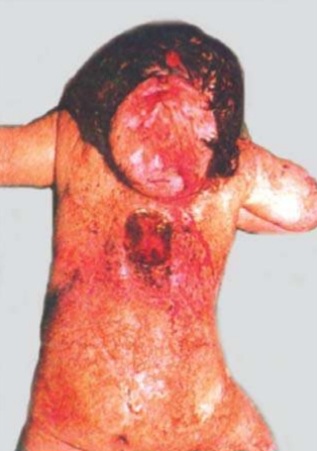 Occipital encephalocele - midline posterior swelling, skin-covered cystic lesion in occipital region