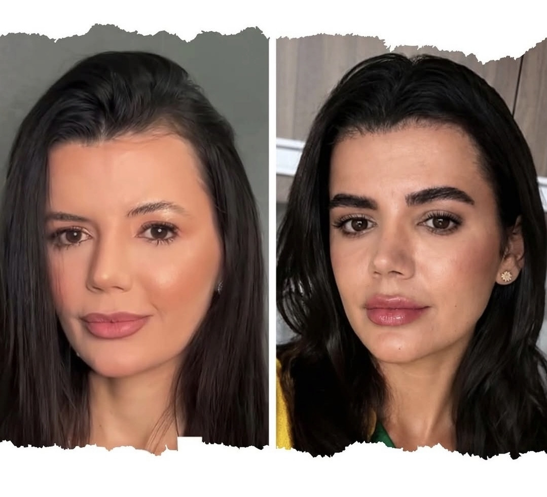 Resultado de transplante de sobrancelhas 2