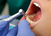 Teeth Cleaning