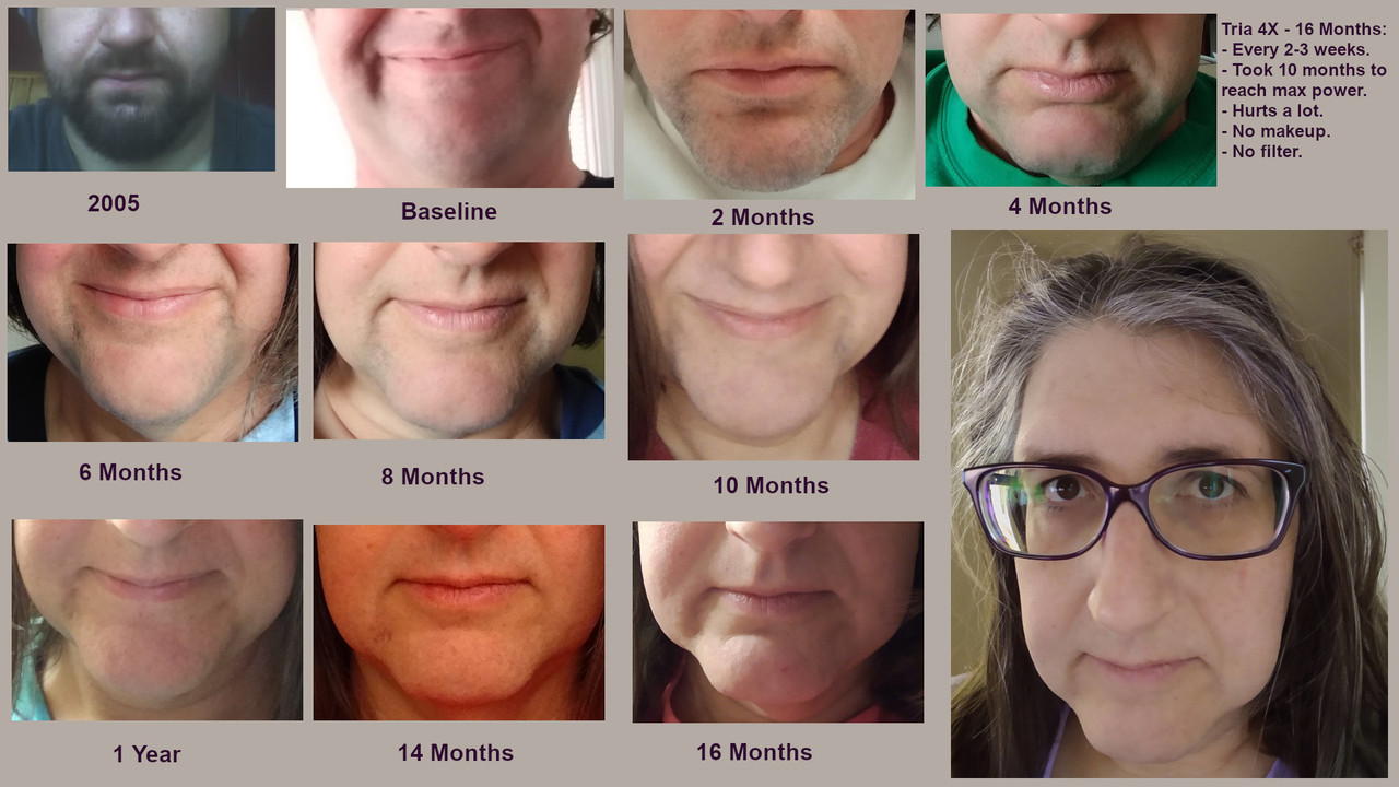 Tria 4X beard removal - 16 month timeline : r/MtF