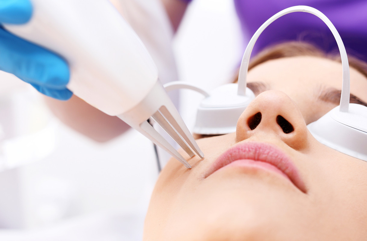 Laser treatment for acne scarring Laser treatment for acne scarring