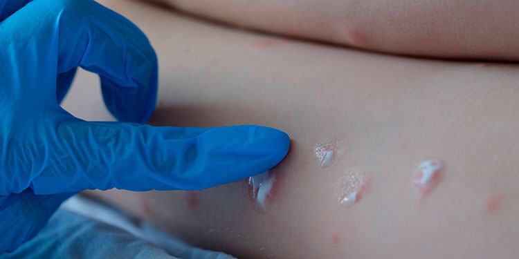 Ya son seis casos sospechosos de viruela del mono en Brasil