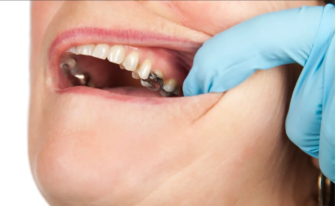 ¿Qué hábitos pueden dañar los dientes? Conócelos y evítalos a toda costa