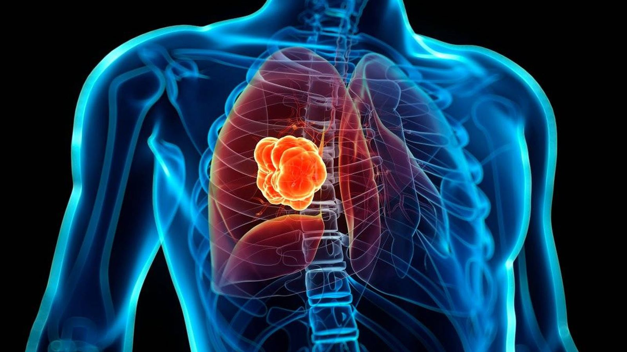 ¿Cómo detectar a tiempo el cáncer de pulmón? Síntomas y diagnóstico