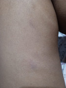 left thigh same spot with p2