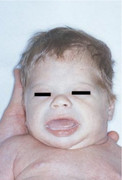 Infant with congenital hypothyroidism showing macroglossia, puffy face, coarse facial features, umbilical hernia