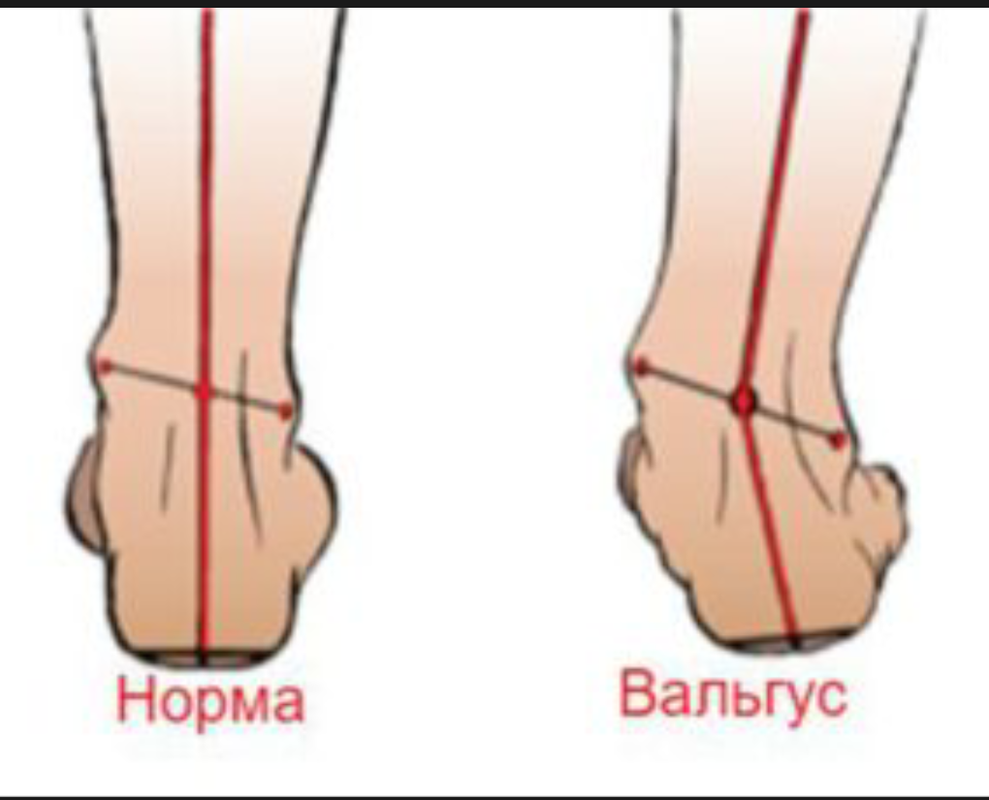 Вальгусная стопа у взрослых операция. Плоско варусная деформация стопы. Плоско вальгусная деформация стопы у детей. Варус вальгусная деформация. Вальгусная и варусная деформация.