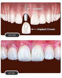 What You Should Know About Osseointegration in Dental Implants thumbnail