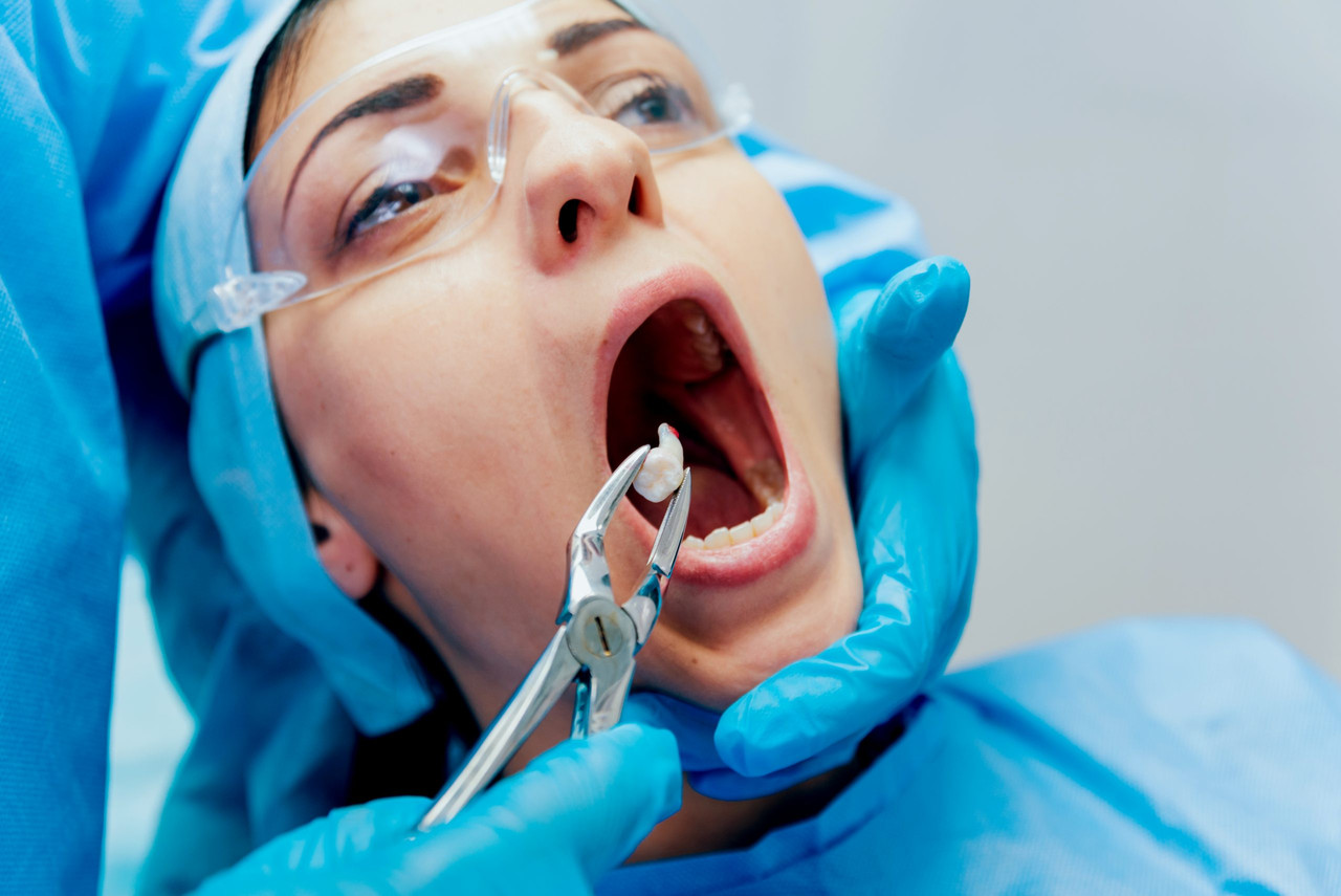 Tooth Extraction Procedure and Instruments