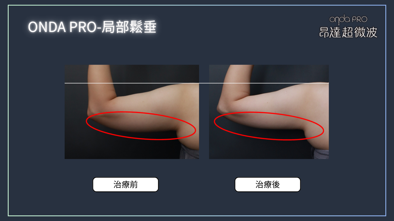 昂達超微波案例：手臂