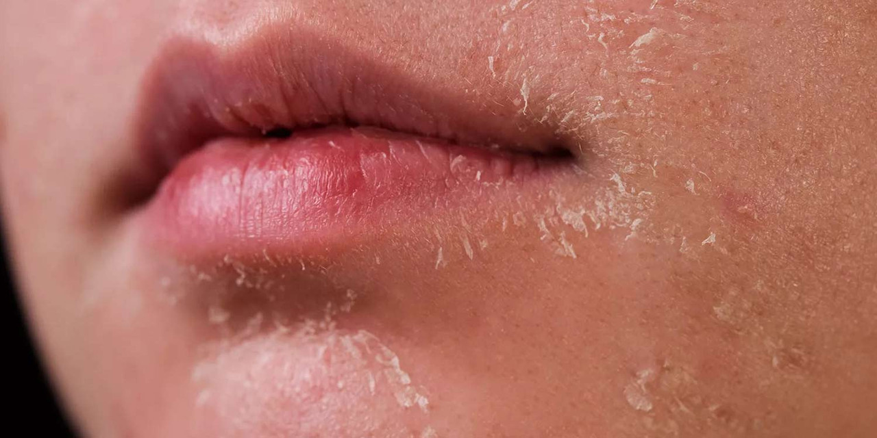 Dry Skin Treatment