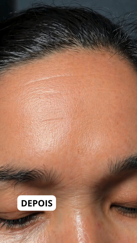 Pele renovada com Dermabem
