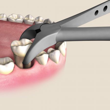 Why Dentists Sometimes Recommend Bicuspid Tooth Extraction
